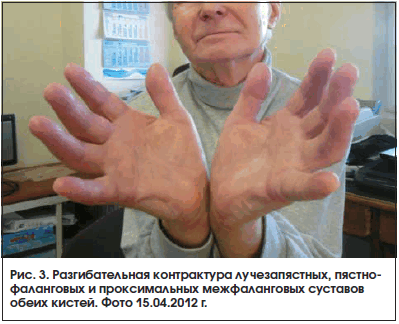 Рис. 3. Разгибательная контрактура лучезапястных, пястно- фаланговых и проксимальных межфаланговых суставов обеих кистей. Фото 15.04.2012 г.