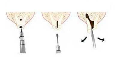 Чем проблемные ретинированные зубы
