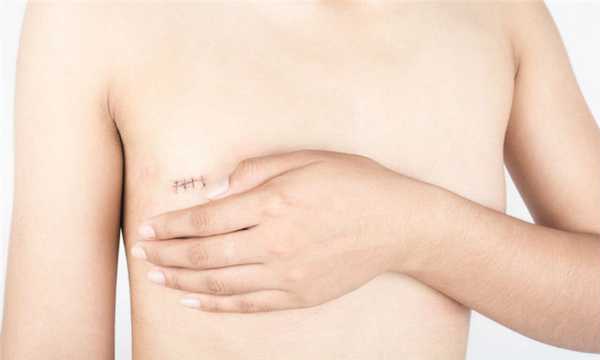 Мастэктомия