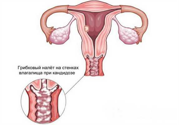 Влагалищный микоз