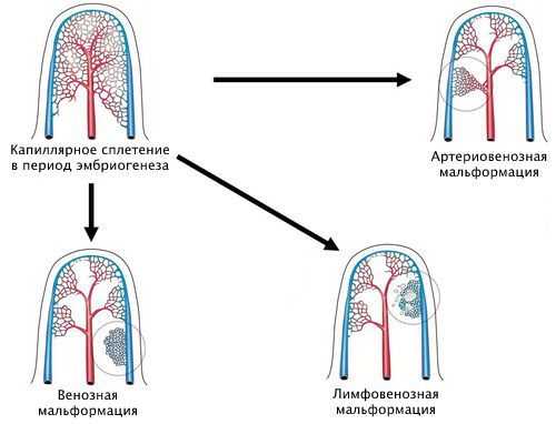 Виды сосудистых аномалий