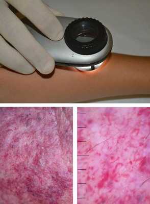 Дерматоскопия капиллярной мальформации