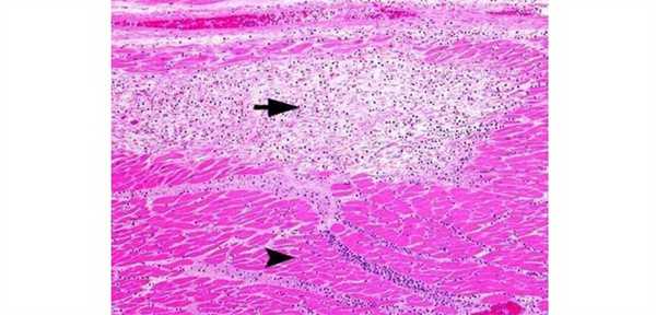 Постинфарктный кардиосклероз