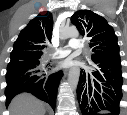 КТ ангиопульмонография позволяет выявить организованные тромбы в легочных артериях