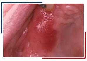 Эритроплакия