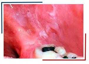 Плоская лейкоплакия