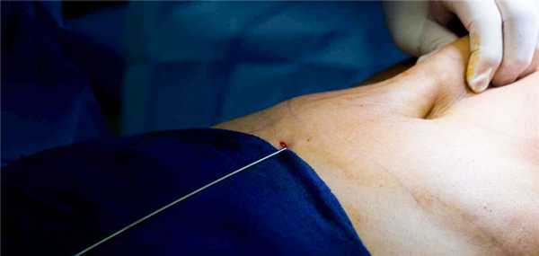 Тумесцентная-липосакция