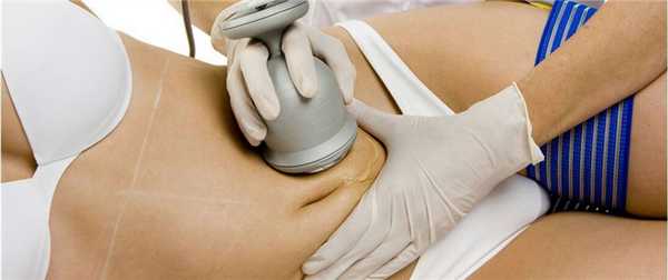 Ультразвуковая липосакция живота