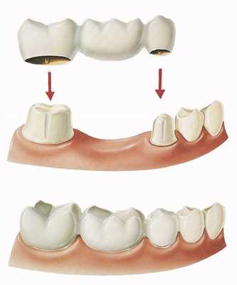 Мостовидный протез