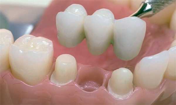 Мостовидный протез