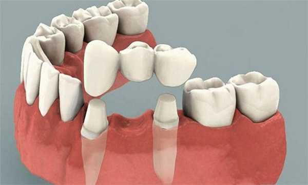 Мостовидный протез
