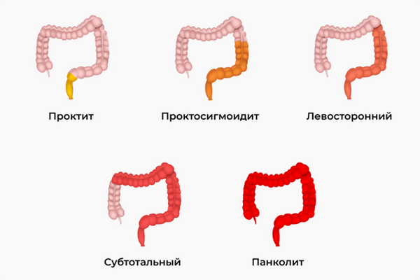 Монреальская классификация язвенного колита по протяженности поражения