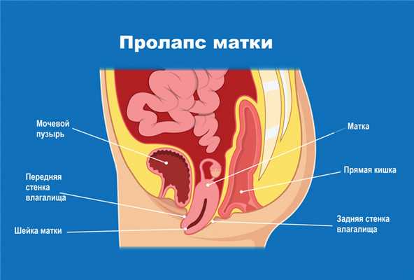 Пролапс матки.jpg