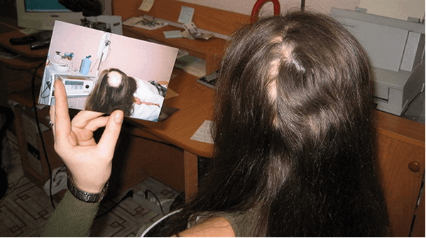 Очаговая алопеция у женщин - причины и лечение