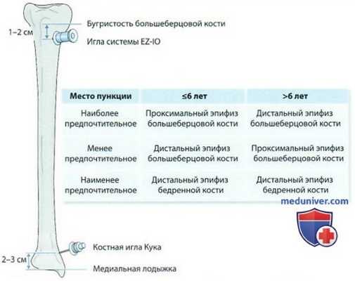 Внутрикостный доступ у детей