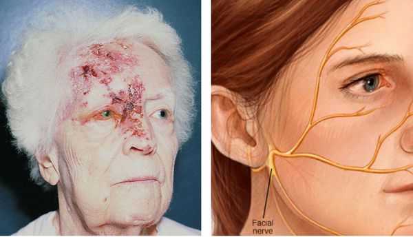 Глазная форма опоясывающего герпеса