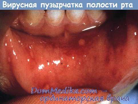 Сыпь на слизистой губы при вирусной пузырчатке полости рта и конечностей