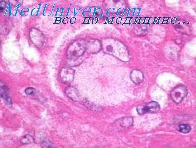 причины саркоидоза