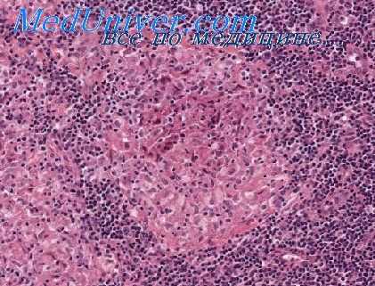 механизмы развития саркоидоза