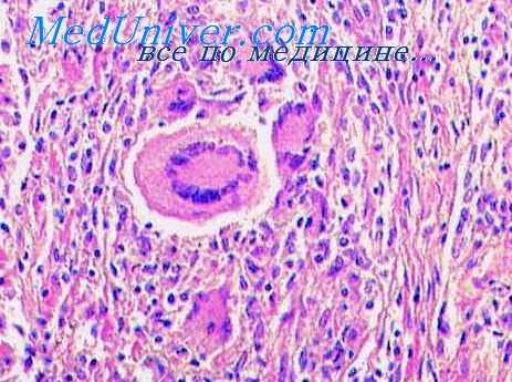 аллергический альвеолит