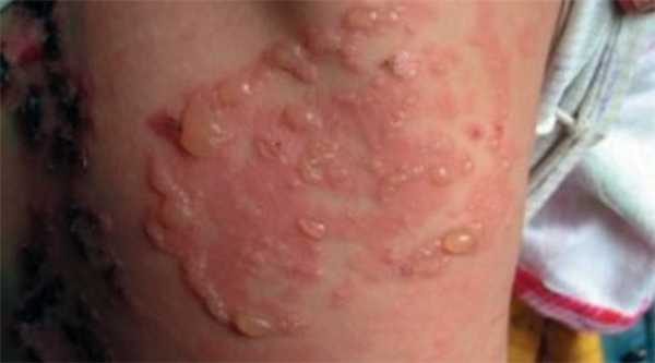 Пузырчатка