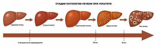 Стадии заболевания печени.jpg
