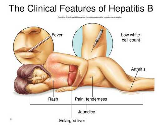 Начальные симптомы гепатита Б
