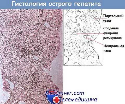 Гистология острого гепатита