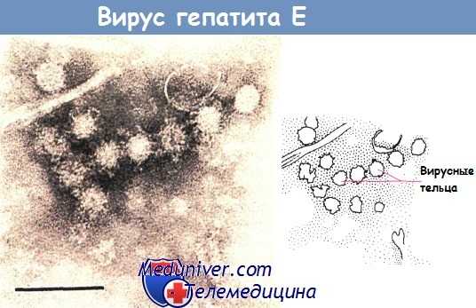 Вирус гепатита Е