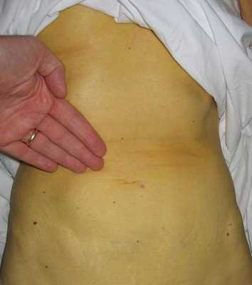 Пожелтение кожи при гепатите Б