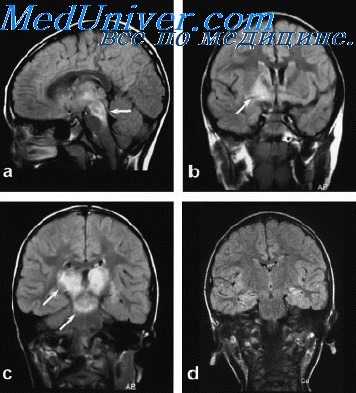 менингоэнцефалиты