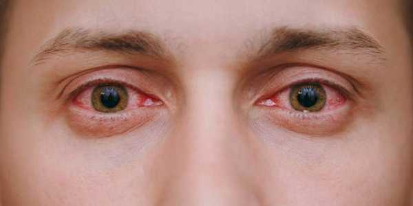 Симптомы вирусного конъюнктивита