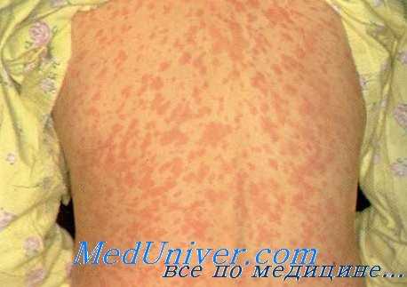 Сыпь у ребенка при кори