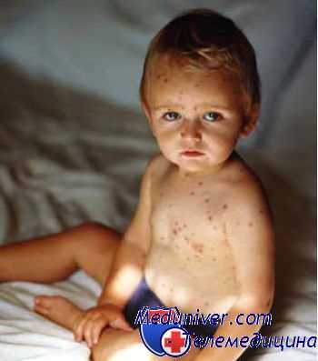 ветрянка у детей
