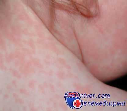 краснуха у детей