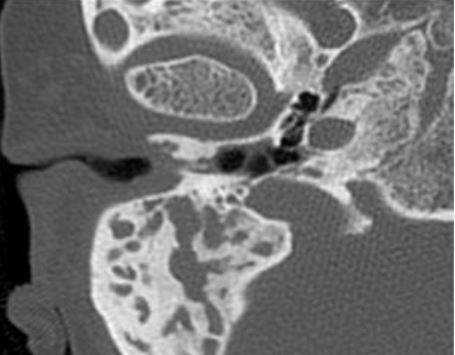 Врожденный порок развития наружного уха. Осевая КТ показывает значительное сужение слухового прохода с его облитерацией из-за нарушения формирования мягких тканей и костей