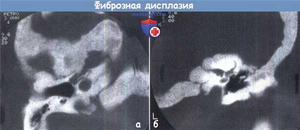 Фиброзная дисплазия височной кости