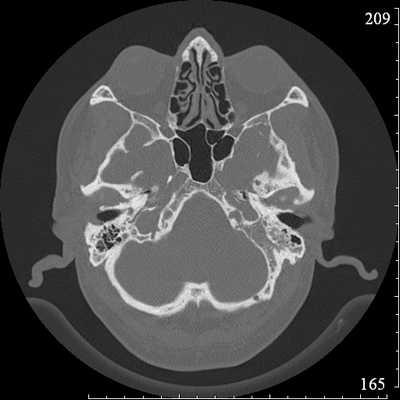 Картинки по запросу кт височных костей