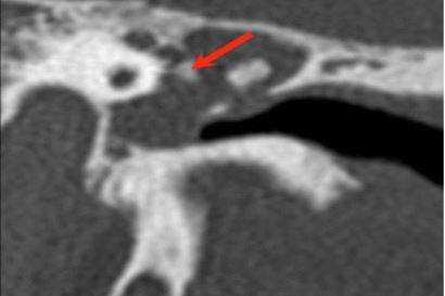 Хроническое воспаление среднего уха: осевая КТ демонстрирует очаговую кальцификацию (стрелка) в барабанной полости - тимпаносклероз.