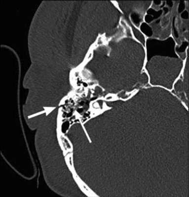 Остеохондрома