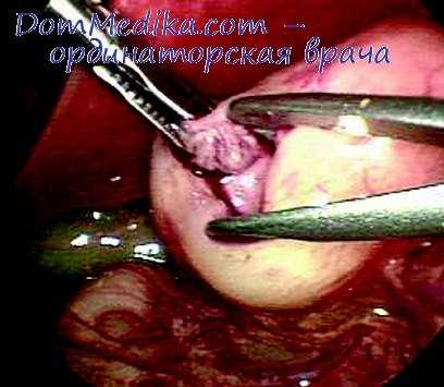 пульмонэктомия