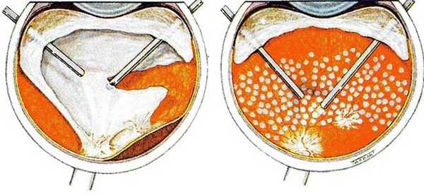 ленсвитрэктомия