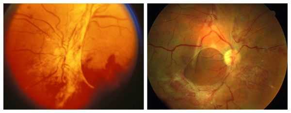 Третья стадия заболевания