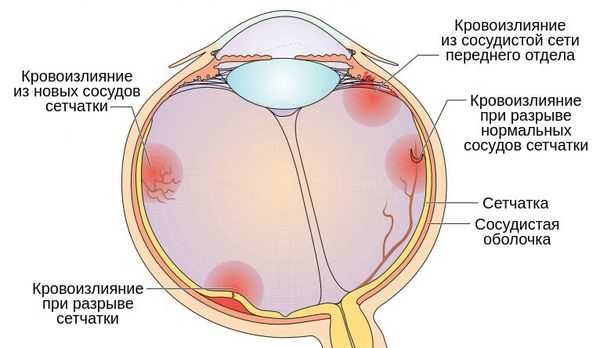 Патогенез гемофтальма