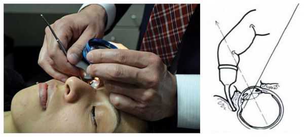 Офтальмоскопия с депрессией склеры