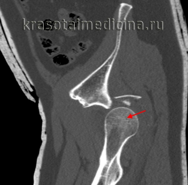 Вывих бедра травматического характера (головка бедренной кости отмечена красной стрелкой).
