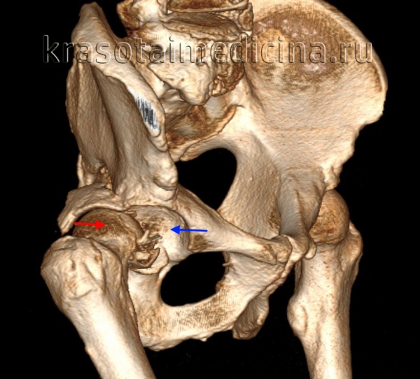 Врожденный вывих бедра