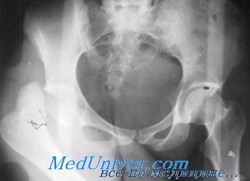 тактика при вывихе бедра