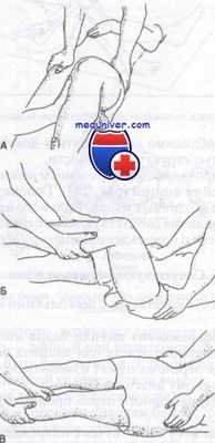 вывих бедра