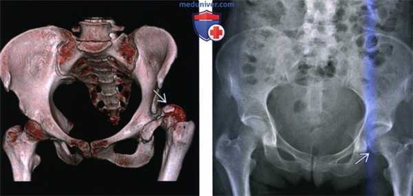 Рентгенограмма, КТ, МРТ при вывихе бедра